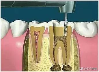 【科普】口腔中心告诉您根管治疗是怎么一回事