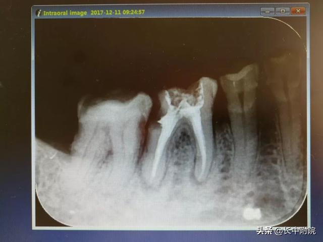 【科普】口腔中心告诉您根管治疗是怎么一回事