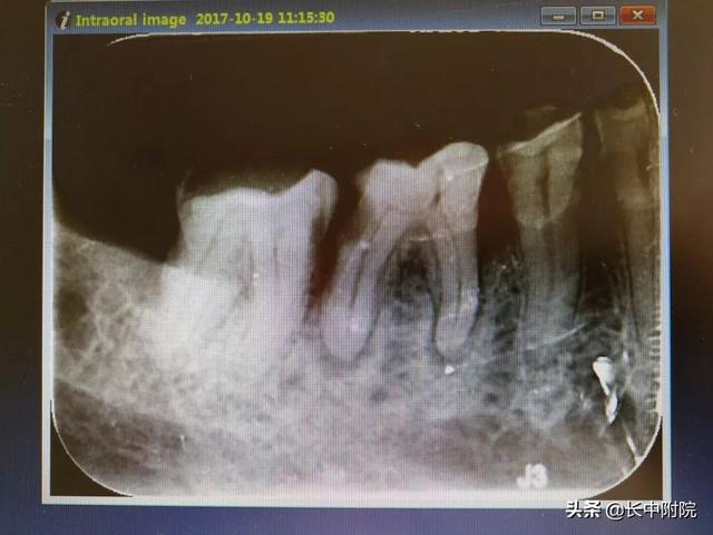 【科普】口腔中心告诉您根管治疗是怎么一回事