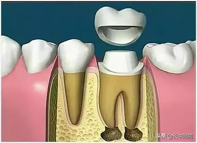 【科普】口腔中心告诉您根管治疗是怎么一回事