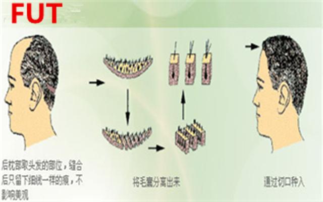 毛发种植术历史