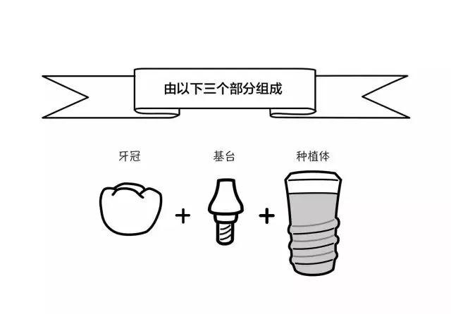 种植体选哪种？挑选秘籍统统告诉你