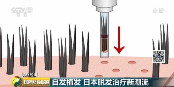 “秃”然变贵！花11万元种了1300根头发？网友：秃不起……