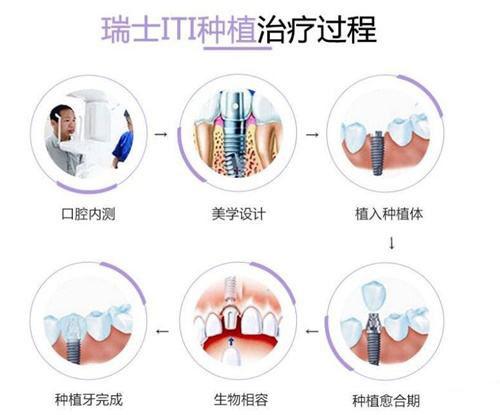 为什么种植系统选择瑞士或者瑞典的植体？其他国家的植体不好吗？