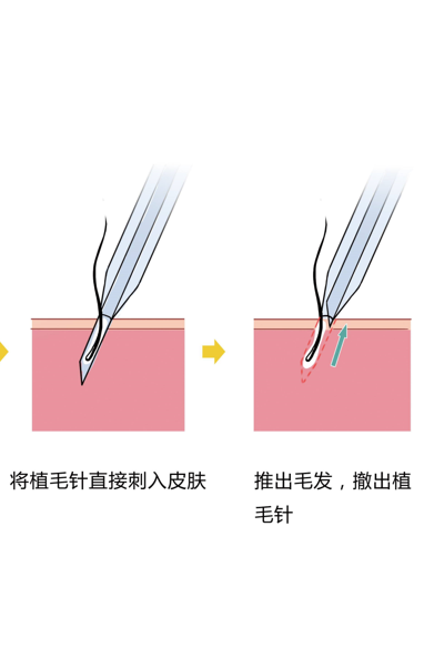 什么是头发种植术？种植之前做好功课，切不可粗心大意