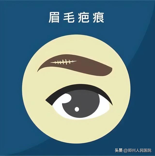 眉毛也能种植啦？想要拥有完美眉毛的朋友看过来