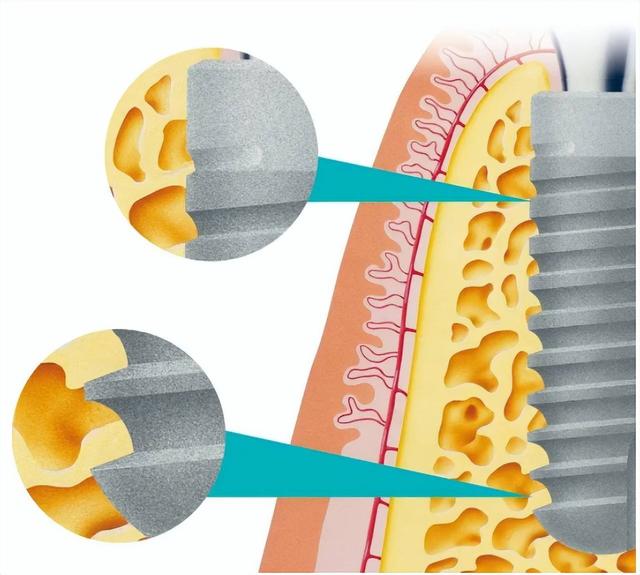 种植体的“SLA”是什么意思？种植体表面处理大揭秘